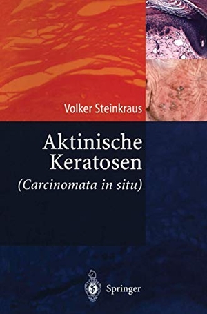Steinkraus, Volker. Aktinische Keratosen (Carcinomata in situ). Springer Berlin Heidelberg, 2004.