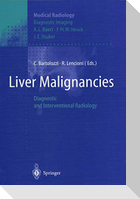 Liver Malignancies