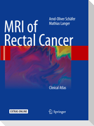 MRI of Rectal Cancer